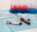 Tubos con muestras de sangre para análisis de glucemia y hemoglobina glicosilada en el laboratorio